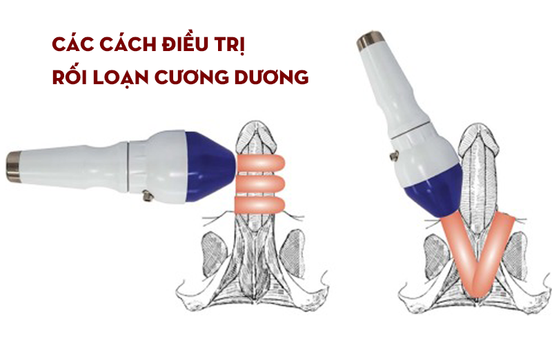Điều trị rối loạn cương dương cần đúng cách, đúng căn nguyên bệnh